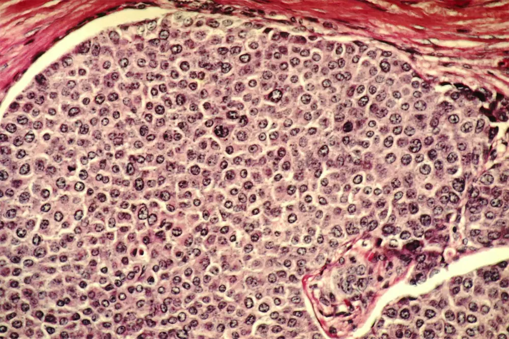 Células cancerigenas
